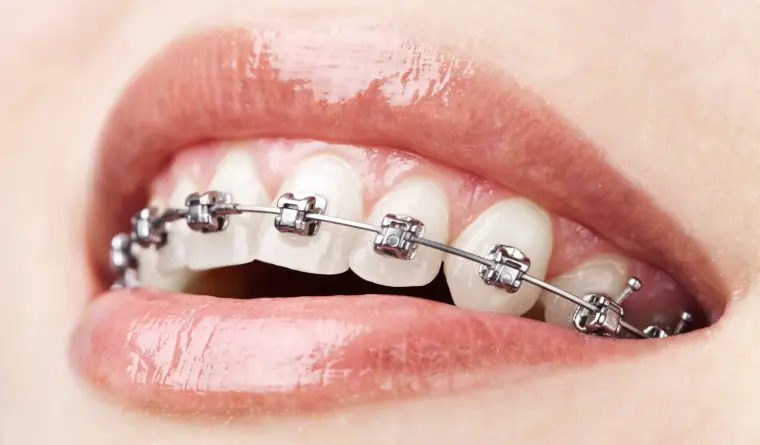 Brackets Autoligado
