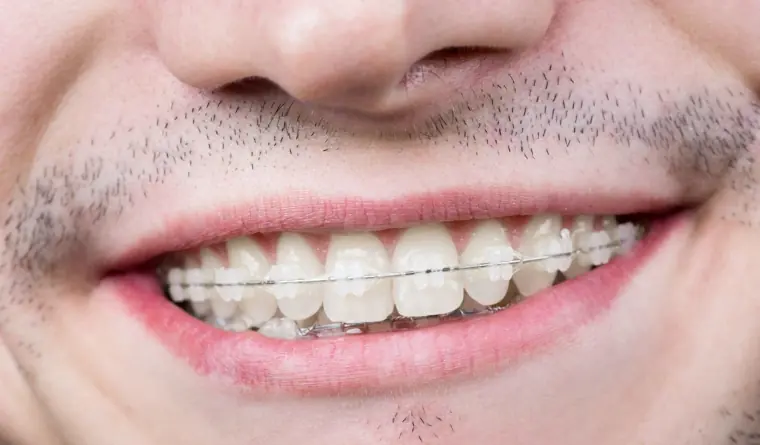 Brackets Cerámica