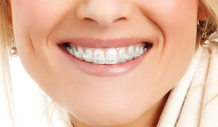 Brackets Zafiro