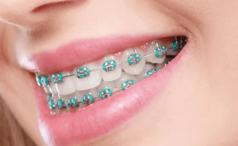 Brackets Metálicos