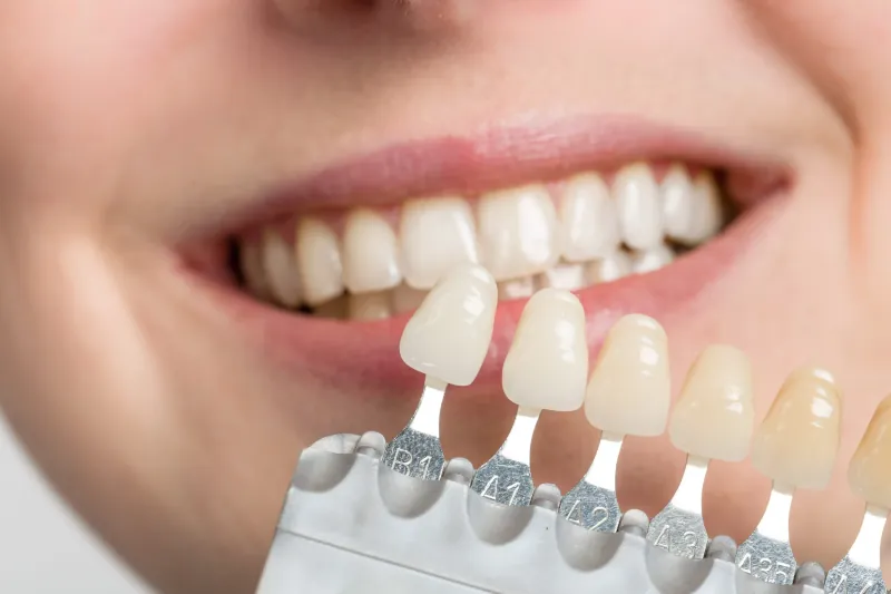 Carillas Dentales