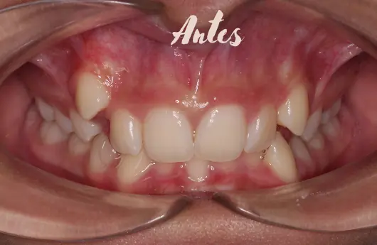 Antes Ortodoncia