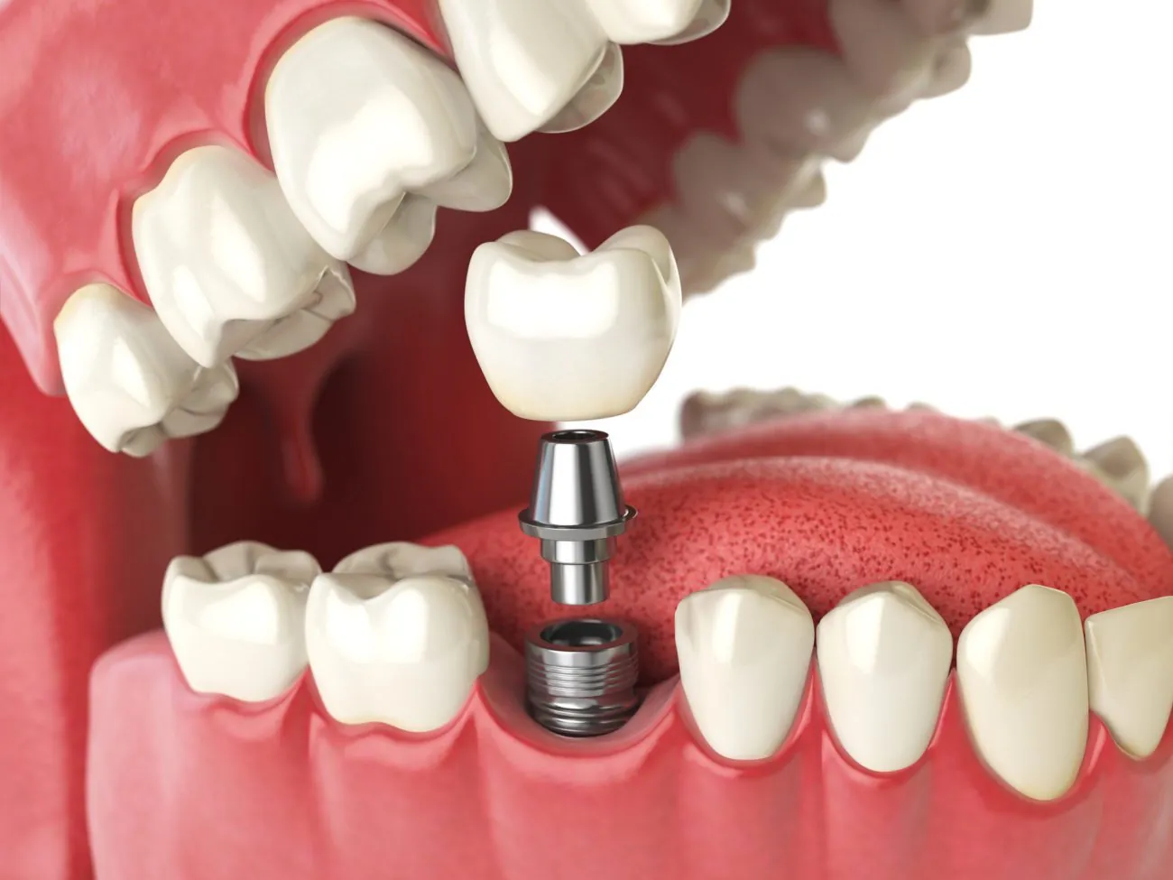 Implantes de Titanio